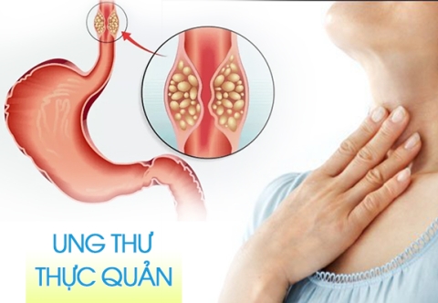 Lời khuyên với các bệnh nhân ung thư thực quản về đề điều trị đa mô thức